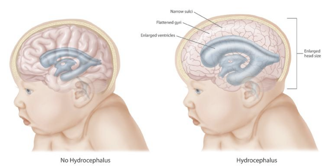 hydrocephalus nursing intervention