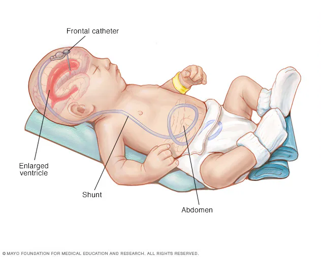 surgical intervention of hydrocephalus